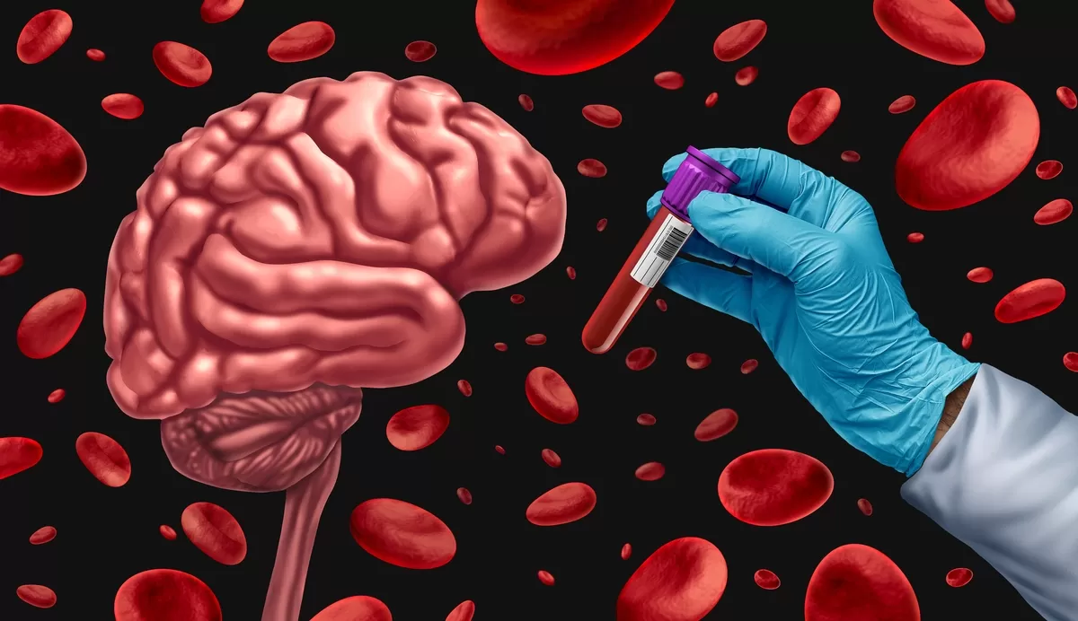 Nuevo análisis de sangre permite detectar el Alzheimer años antes de los primeros síntomas