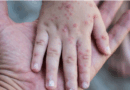 Alerta por Virus Coxsackie: Afecta Principalmente a Niños y No Tiene Tratamiento Específico