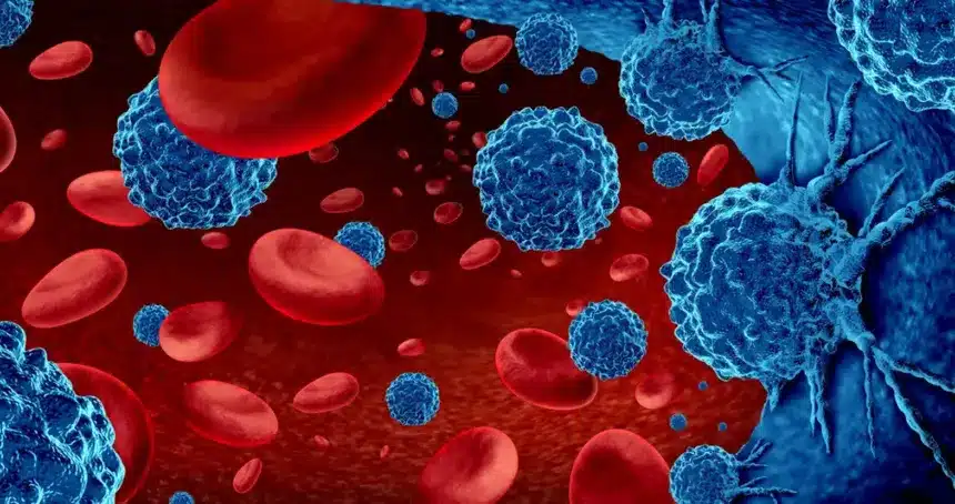 efe archiv por leucemia linfoblastica