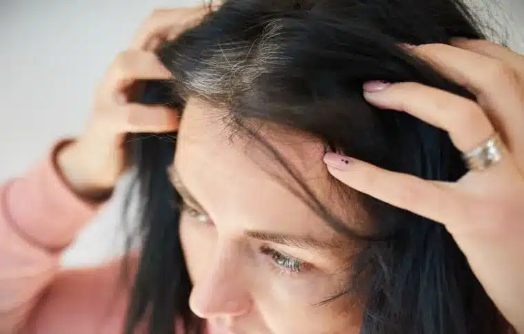 picor cuero cabelludo 760x485 1