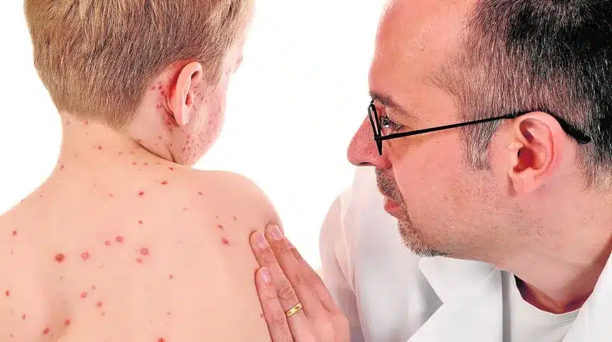 Sarampión no es historia: datos muestran su regreso preocupante 1 sarampion kHv