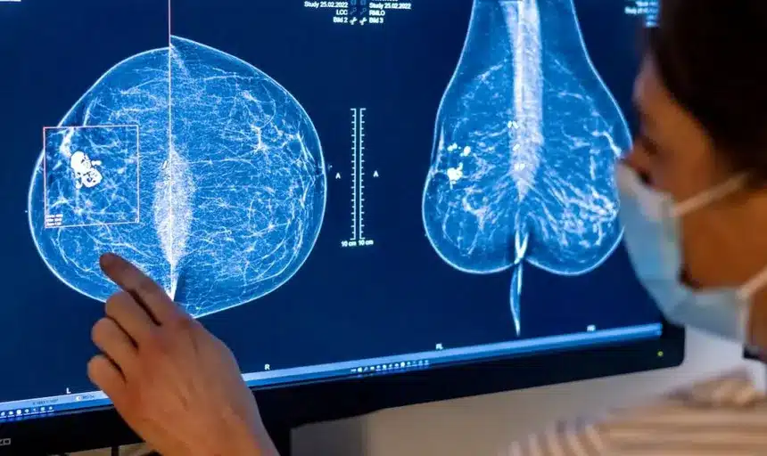 La inteligencia artificial mejora la deteccion temprana de cancer de 980x583 1