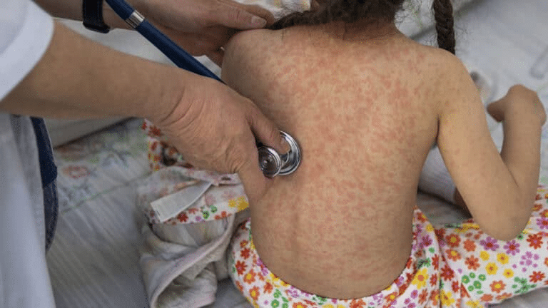 Reportan nueva muerte por sarampión en México 1 image 155