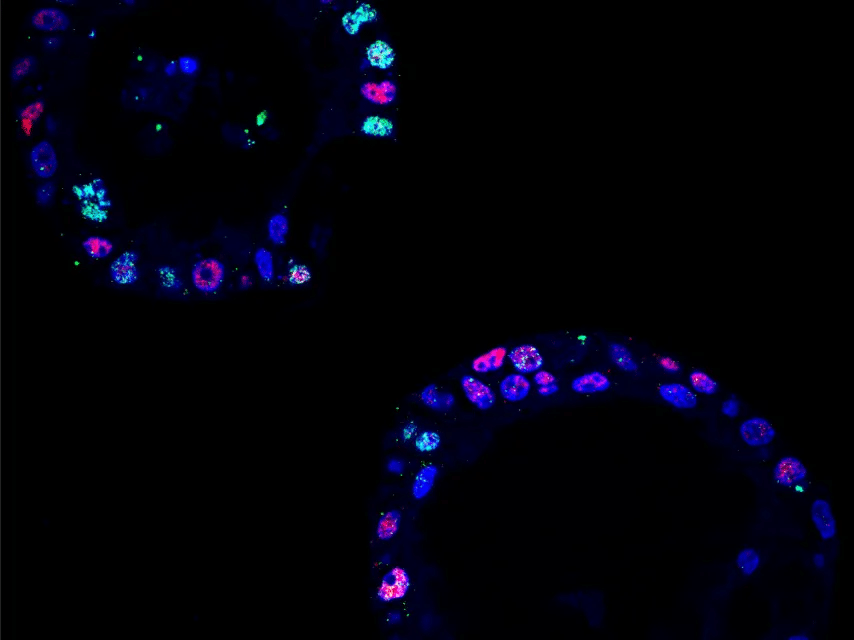 Descubren proteína que protege al cáncer de páncreas de las defensas del organismo